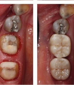 before-after photo implantacia-zuba