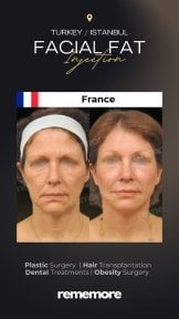 before-after photo lipofilling
