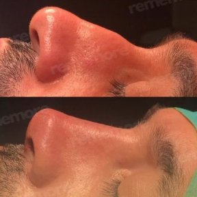 before-after photo septoplasty