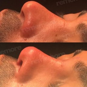 before-after photo septoplasty