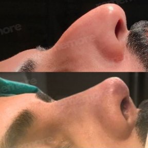 before-after photo septoplasty