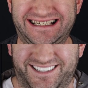 before-after photo dental-implant