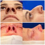 Before and after rhinoplasty results at Novia Estetica, nose reshaping with improved contour