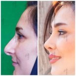 Before and after rhinoplasty results, nose reshaping for improved profile at clinic