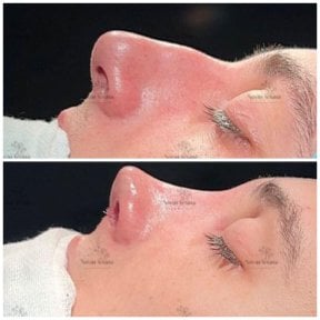 Before and after rhinoplasty results, nose reshaping with improved profile and contour
