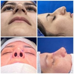 Before and after rhinoplasty results, nose reshaping procedure with improved profile