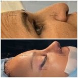 Before and after rhinoplasty results at Novin Grata Clinic, improved nose shape profile