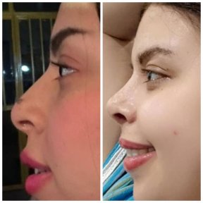 Before and after rhinoplasty results, improved nose shape and profile after surgery