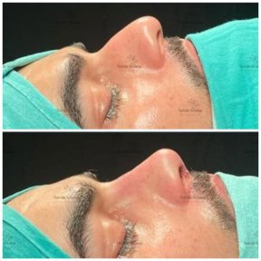 Before and after rhinoplasty results, nose reshaping for improved profile at Novia Estetica