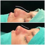 Before and after rhinoplasty results at Novia Estetica, nose reshaping with improved profile