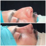 Before and after rhinoplasty results in male patient, nose reshaping with natural contour