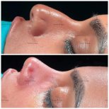 Before and after rhinoplasty results, nose reshaping with improved profile and contour