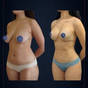 before-after photo lipofilling