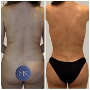 before-after photo lipofilling