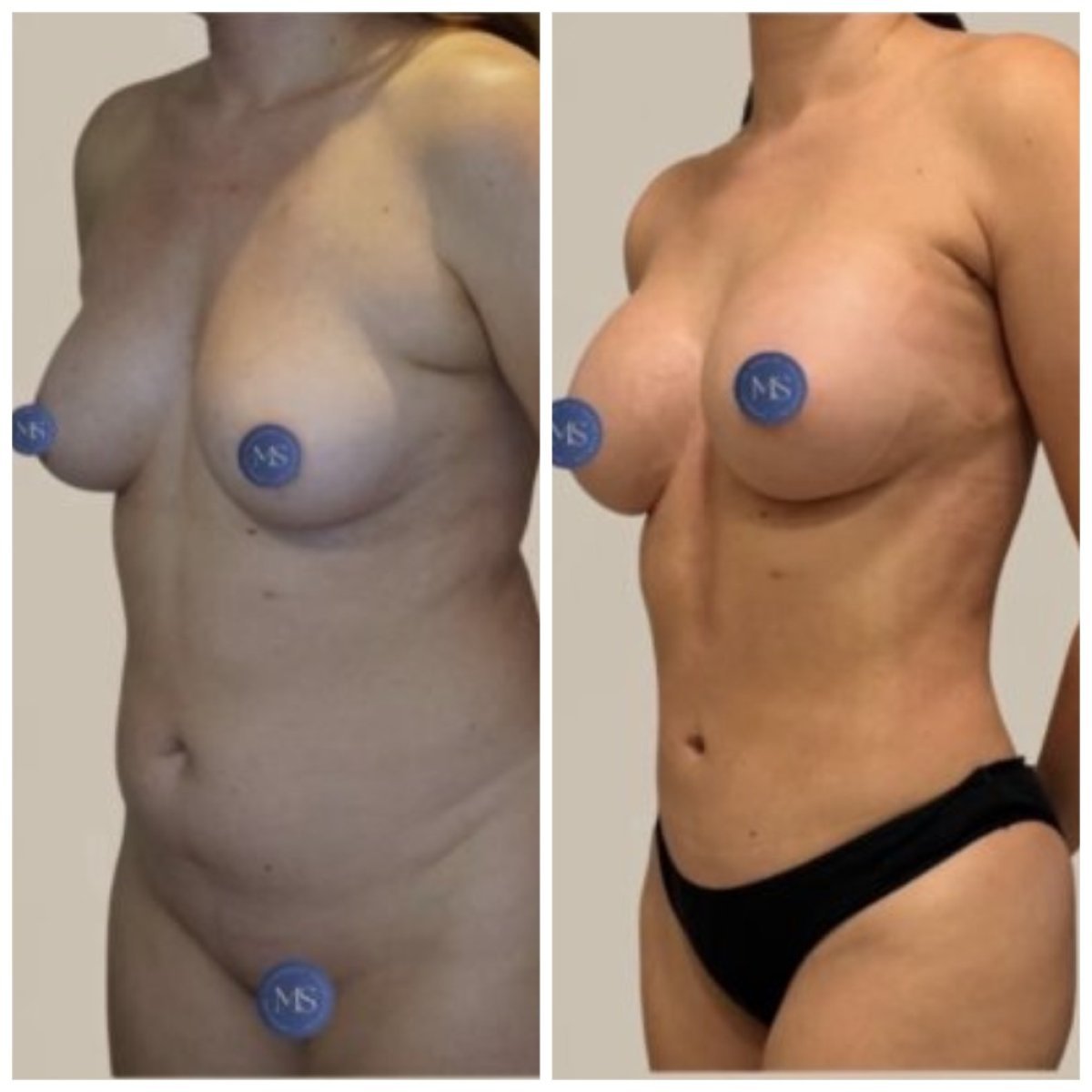 Resultados de lipofilling antes y después en Dr. Michel Salameh - contorno corporal estético