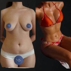 before-after photo lipofilling