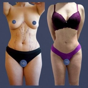 before-after photo lipofilling