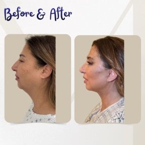 before-after photo tightening-of-facial-skin-facelift