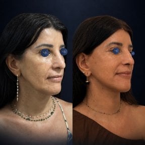 before-after photo tightening-of-facial-skin-facelift