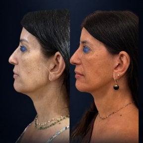 before-after photo tightening-of-facial-skin-facelift