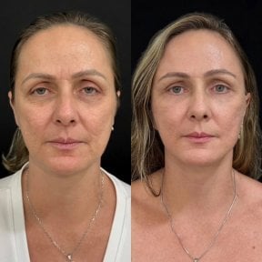 before-after photo tightening-of-facial-skin-facelift