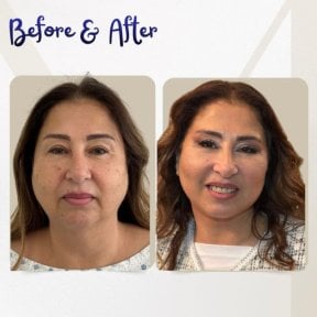 before-after photo tightening-of-facial-skin-facelift