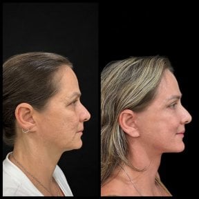before-after photo tightening-of-facial-skin-facelift