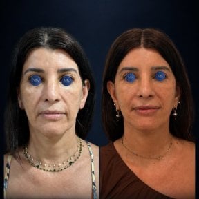 before-after photo deep-plane-facelift
