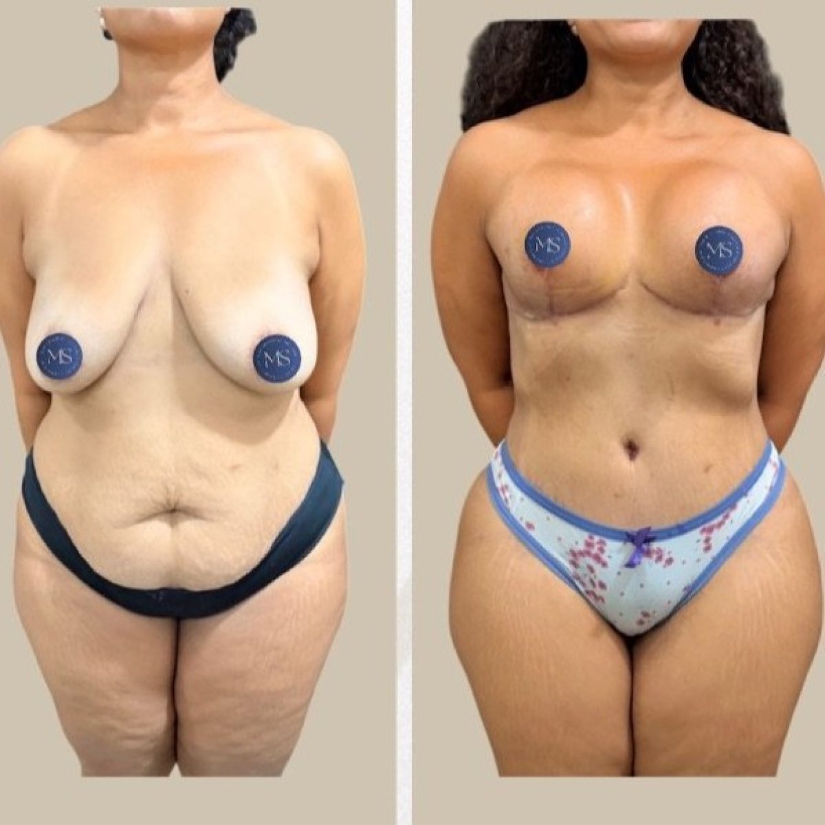 نتائج قبل وبعد عملية تجميل الأم في Dr. Michel Salameh - Plastic And Aesthetic Surgery