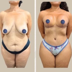 before-after photo mommy-makeover