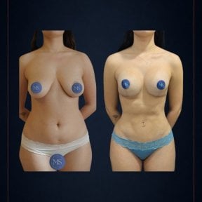 before-after photo liposculpture