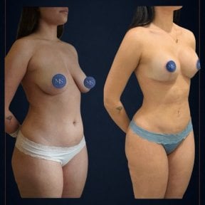 before-after photo liposculpture