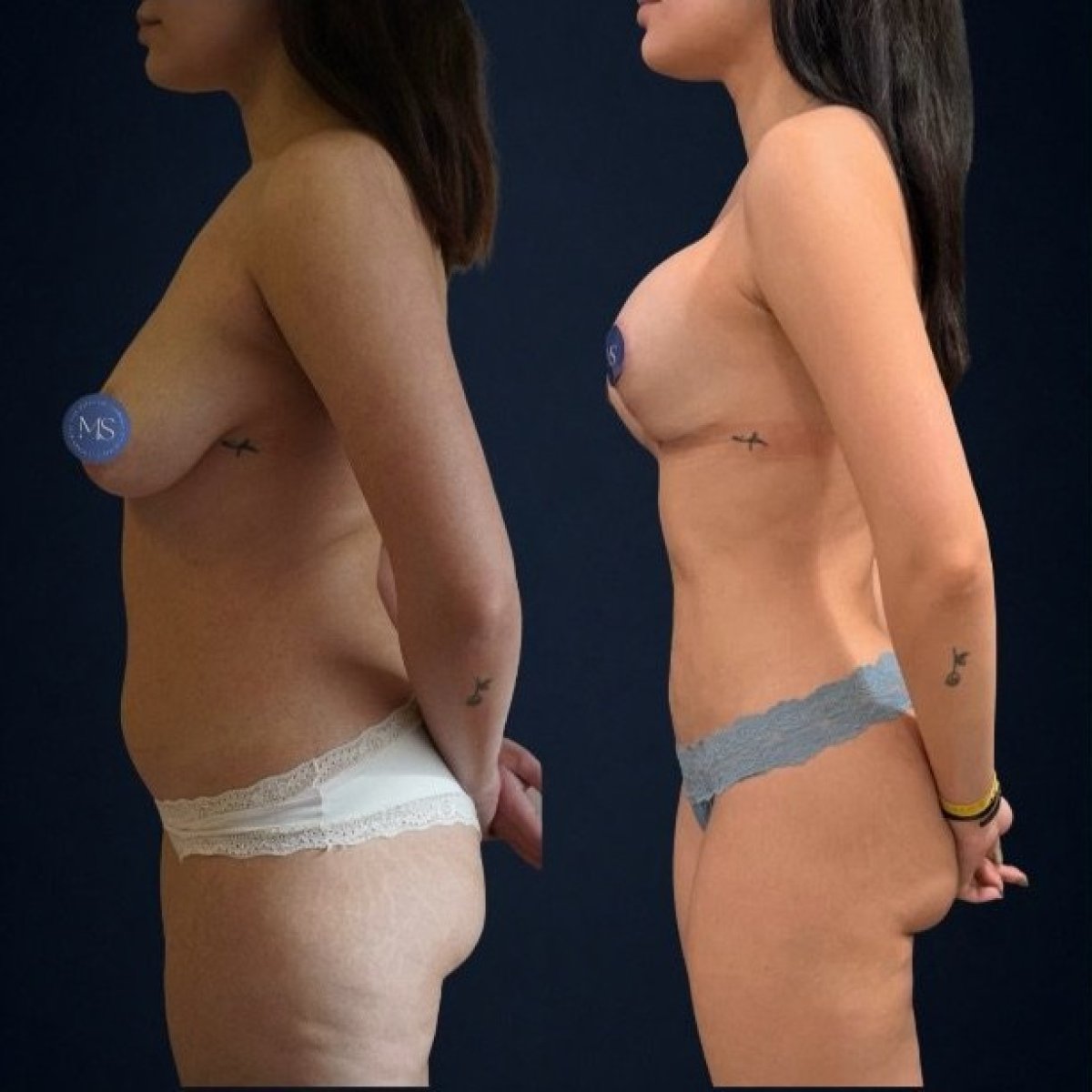نتائج نحت الجسم قبل وبعد في Dr. Michel Salameh - Plastic And Aesthetic Surgery