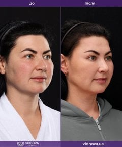 Resultados antes y después de lifting facial deep plane en Vidnova Clinic – rejuvenecimiento facial
