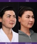 Resultados antes y después de lifting facial deep plane en Vidnova Clinic – rejuvenecimiento facial