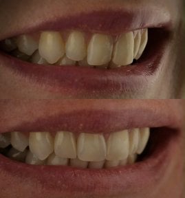 before-after photo dental-bonding