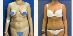 Before and after liposuction results at Memorial Ankara Hospital, visible body contour improvement