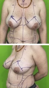 before-after photo liposuction