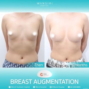before-after photo breast-augmentation