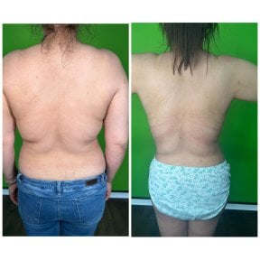 before-after photo liposuction
