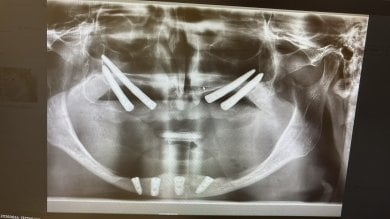 Résultat d’implant zygomatique en radiographie chez Soraca Med, pose dans la mâchoire supérieure