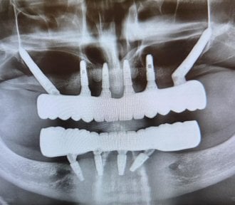Résultat d’implant zygomatique chez Soraca Med, radio de restauration complète