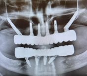 Résultat d’implant zygomatique chez Soraca Med, radio de restauration complète
