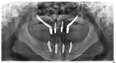 Résultat d’implant zygomatique chez Soraca Med – radio montrant implants supérieurs et inférieurs