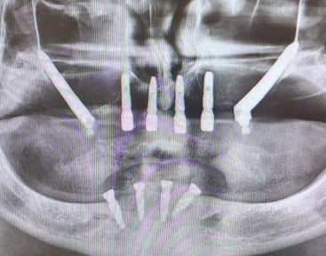 Résultat radiographique après implants zygomatiques chez Soraca Med, restauration maxillaire