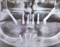 Résultat radiographique après implants zygomatiques chez Soraca Med, restauration maxillaire