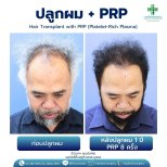 Результат до і після пересадки волосся з PRP в Intrarat Hospital – густіша лінія волосся