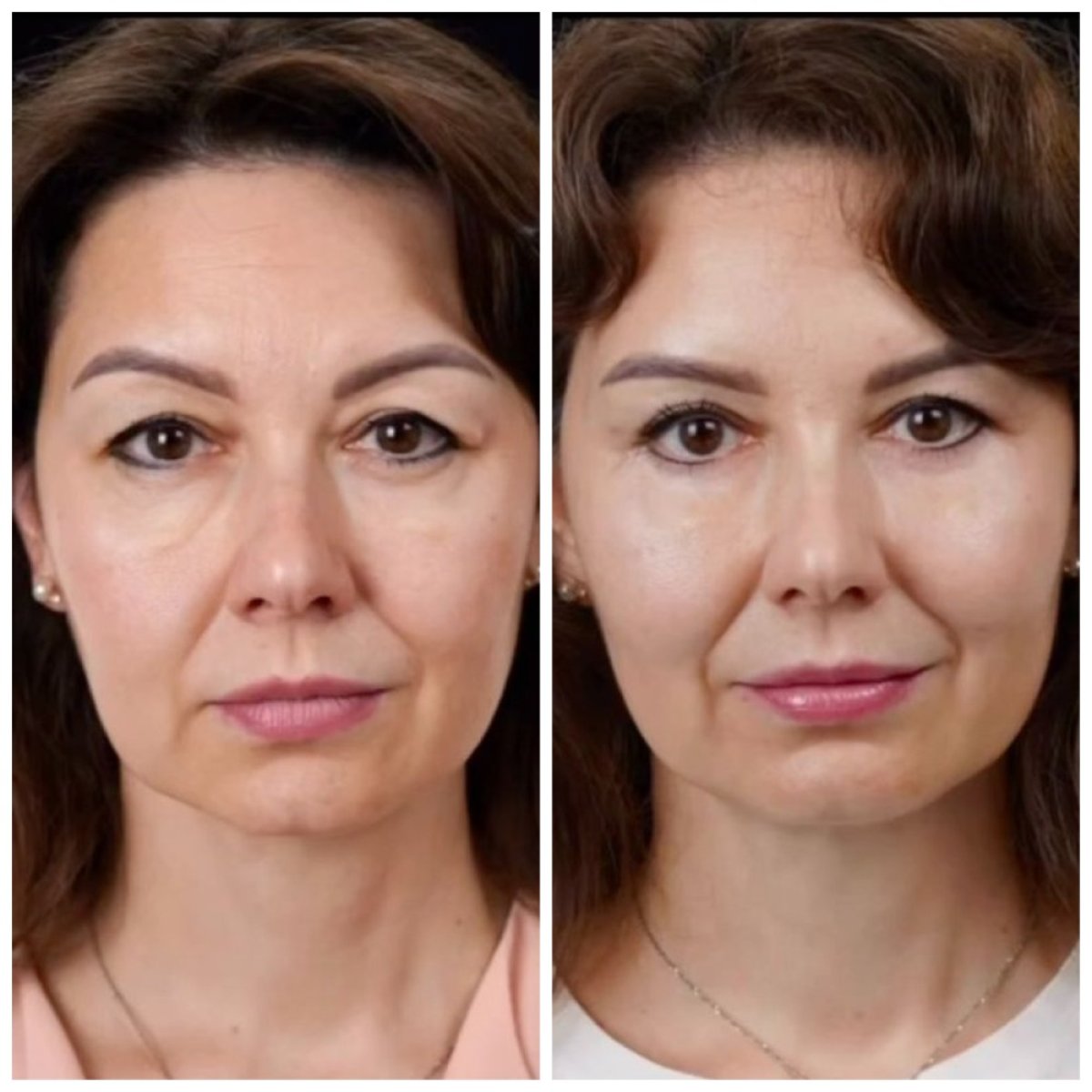 نتائج شد الوجه قبل وبعد في Yurchenko Plastic Surgery Team Kyiv، تجديد شباب الوجه
