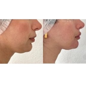 Before and after hyaluronic acid fillers result for chin enhancement at Punta cana dentist