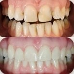 Efekty przed i po bondingowaniu zębów w Punta cana dentist odontologia familiar, poprawiony uśmiech